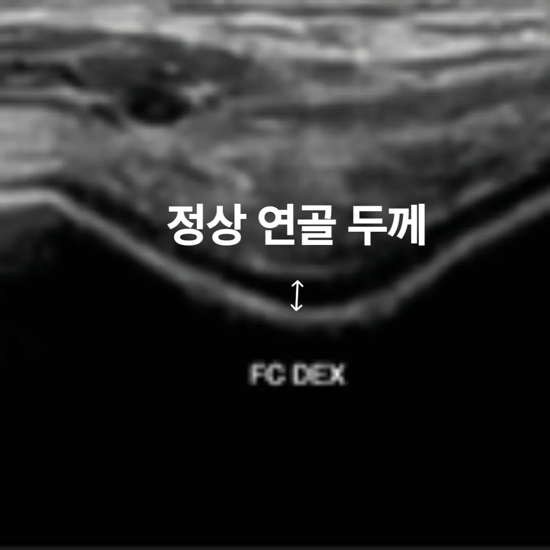 Grade 0 초음파